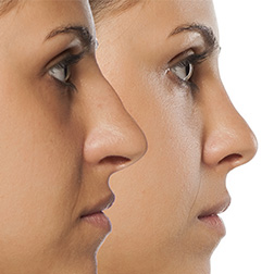 Rhinoplasty - Nose Surgery