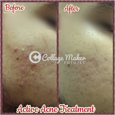 Acne Scar Treatment - Testimonials