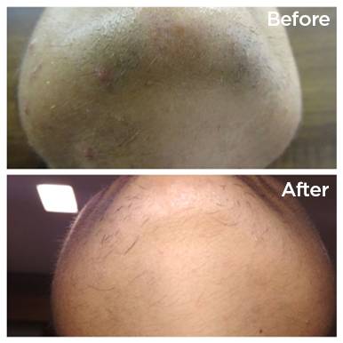 Laser Hair Reduction & Removal - Testimonials