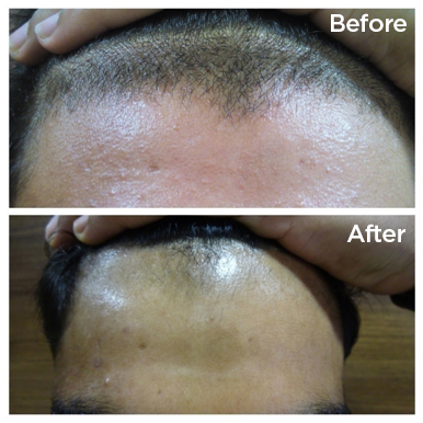 Laser Hair Reduction & Removal - Testimonials