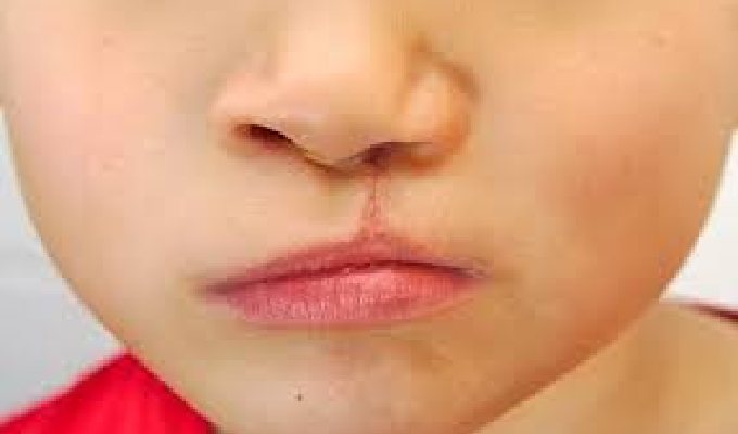 Process of Cleft lip Surgery