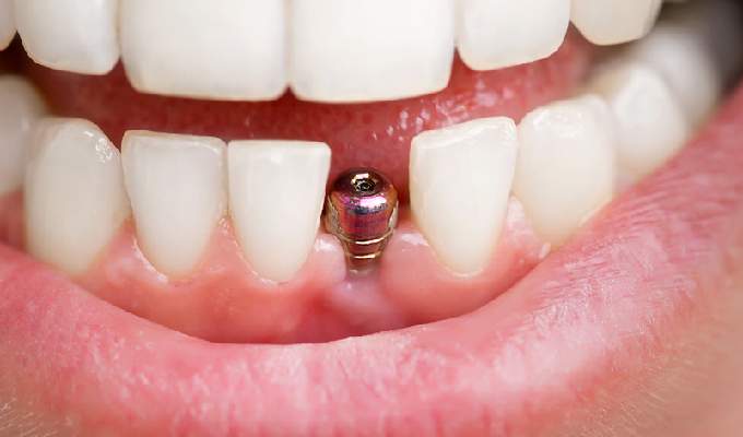 What is Dental Implant?