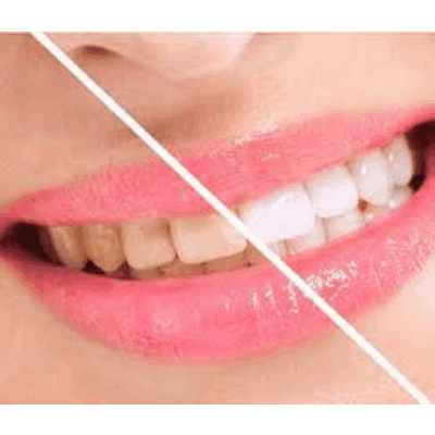 Benefits of Dental Spa/Dental Cleaning
