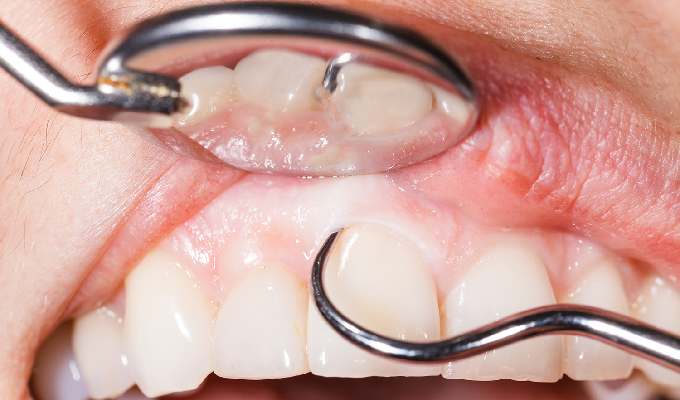 Gum infection Treatment or Periodontal Surgery