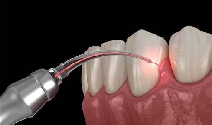 Why Periodontal Surgery?