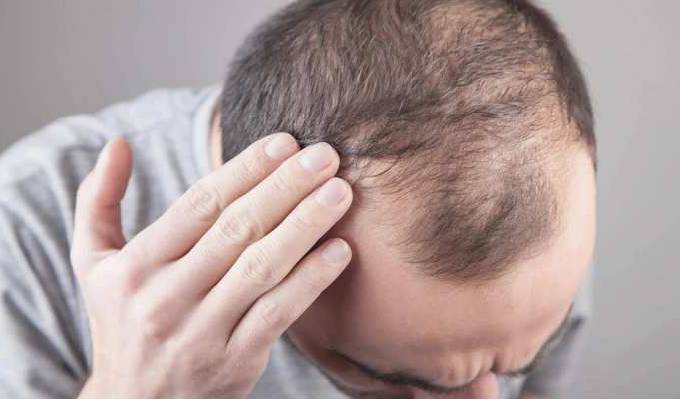 Treatment Methods of Hair Loss