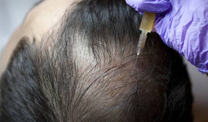 PRP Treatment for Hair Loss