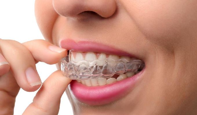 Orthodontic Braces Methods