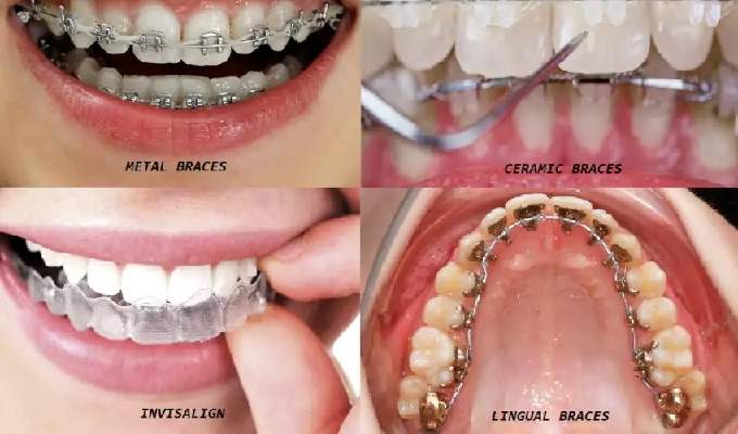 Types of Braces for Teeth