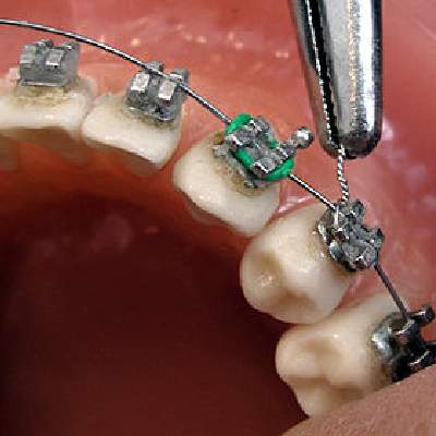 Process of Orthodontic Treatment