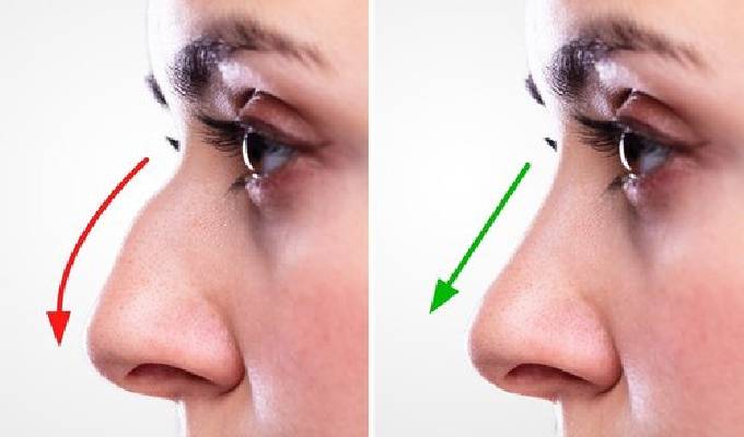 Process of Nose Reshaping Treatment