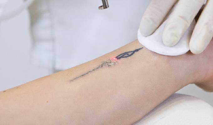 Why Permanent Tattoo Removal?