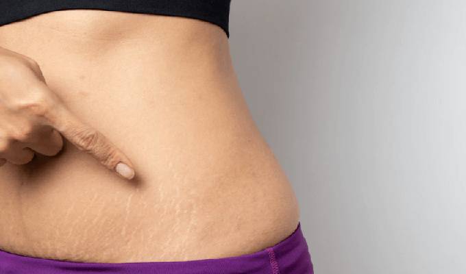 Why Stretch Mark Removal?