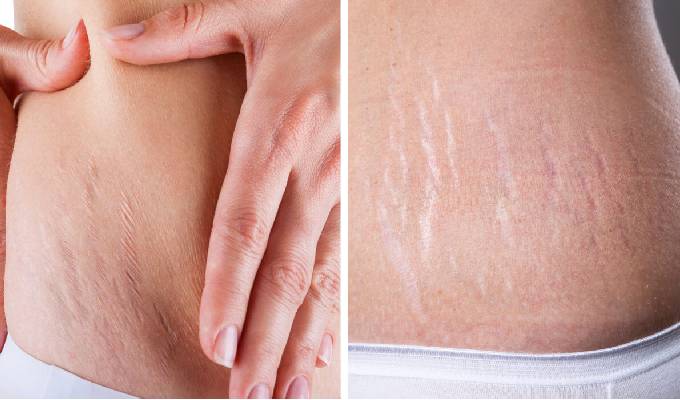 How Stretch Marks are Formed?