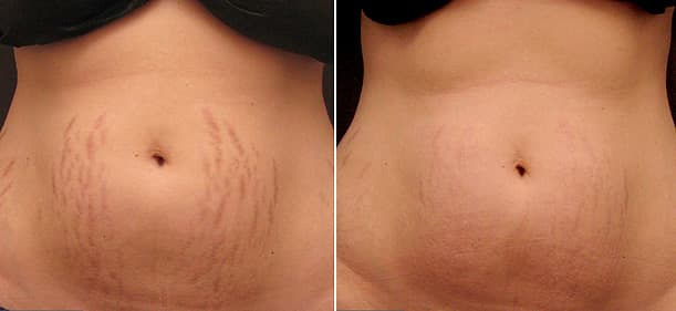 Benefits of Stretch Marks Removal Treatment
