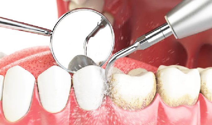 What is Teeth Cleaning or Teeth Scaling