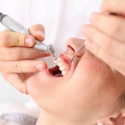 Procedure for Teeth Scaling/ Teeth Cleaning