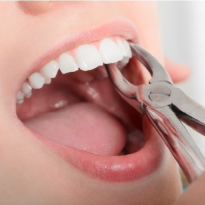 Reasons: Extraction of teeth