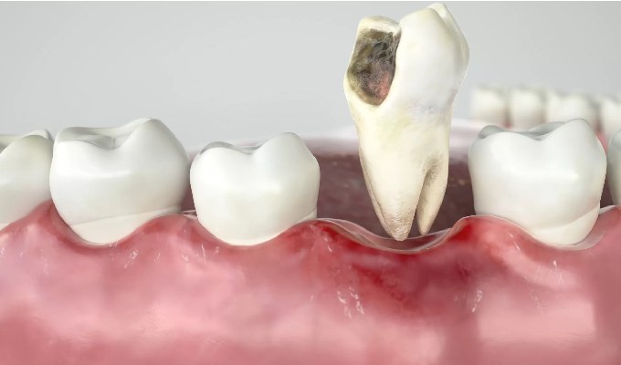 Teeth Extraction