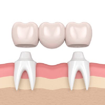 Benefits of Tooth Extraction