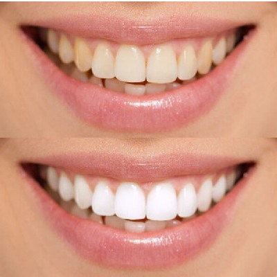 Benefits of Laser Teeth Whitening Treatment